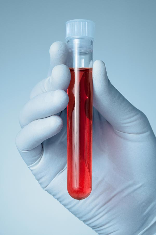 Close up of a gloved hand holding a vial of red liquid, representing Dr. Bahar Amin's comprehensive autoimmune disorder treatment in North York.