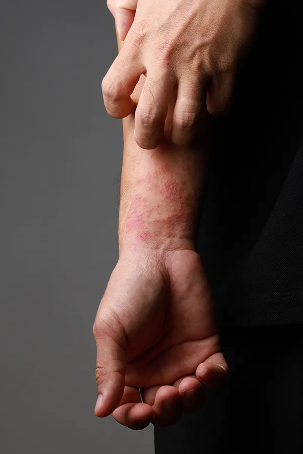 One hand scratches an area irritated by eczema on the other wrist. Get treatment for eczema from Dr. Bahar Amin in North York.