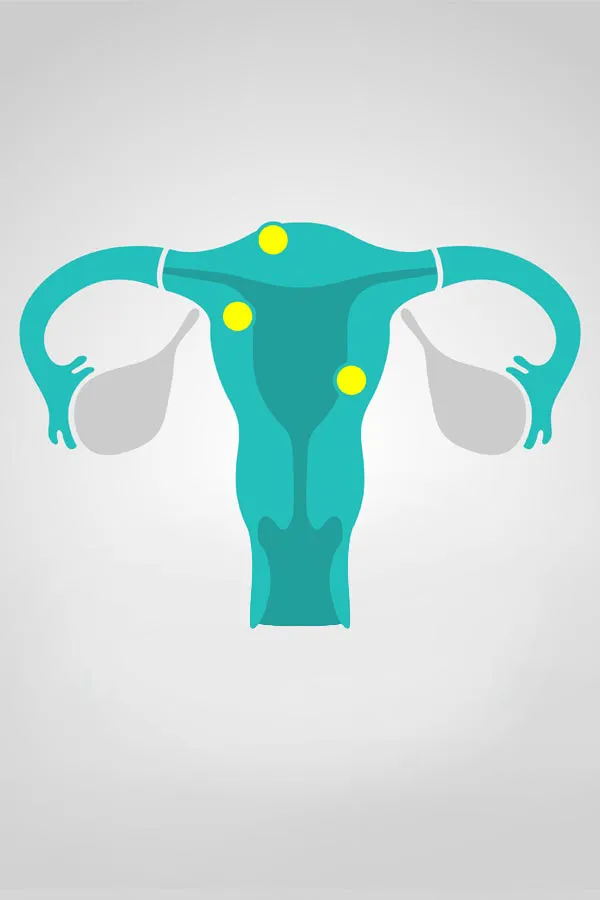 Illustration of a uterus with yellow dots indicating fibroids. Get treatment for fibroids from Dr. Bahar Amin in North York.
