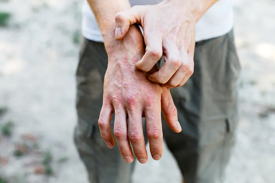 Close-up of a man scratching his hands while experiencing Psoriasis. Get care for Psoriasis from Dr. Bahar Amin in North York.