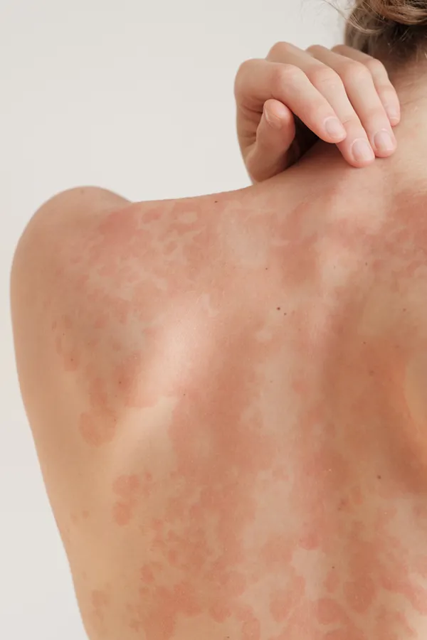 The back and shoulder of a woman experiencing Psoriasis. Get treatment for Psoriasis from Dr. Bahar Amin in North York.