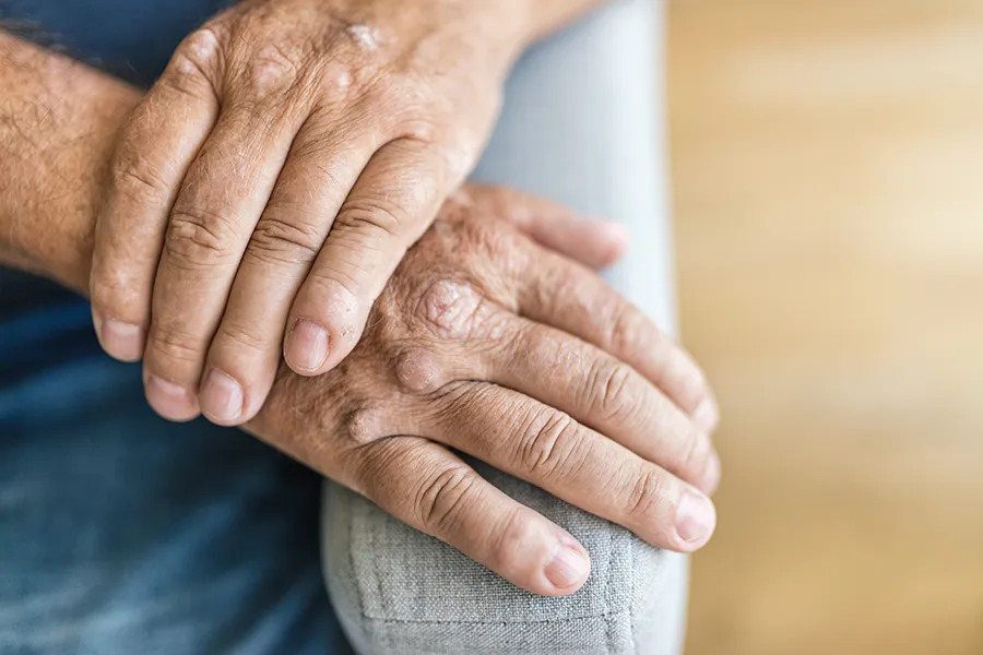 Close-up of a mature mans hands showing signs of psoriatic arthritis. Get treatment for psoriatic arthritis from Dr. Bahar Amin in North York.