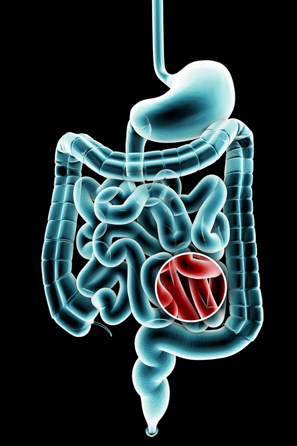 3D illustration of the digestive system in blue tones, with an area of discomfort in red tones. Get treatment for Ulcerative Colitis from Dr. Bahar Amin in North York.